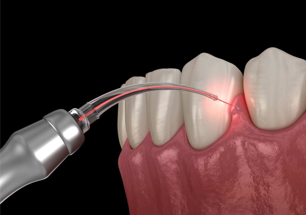 kadıkoy_Lazer_Destekli_Periodontal_Tedavi